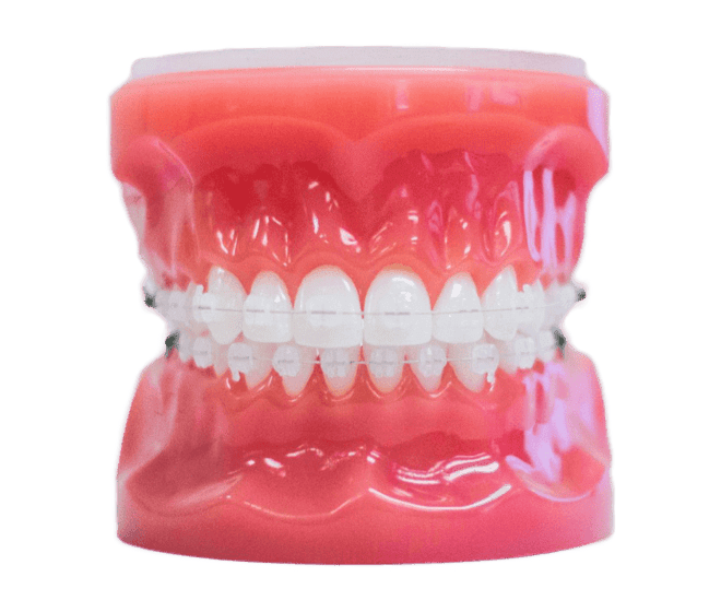 clear braces