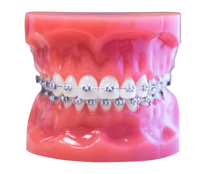 metal braces