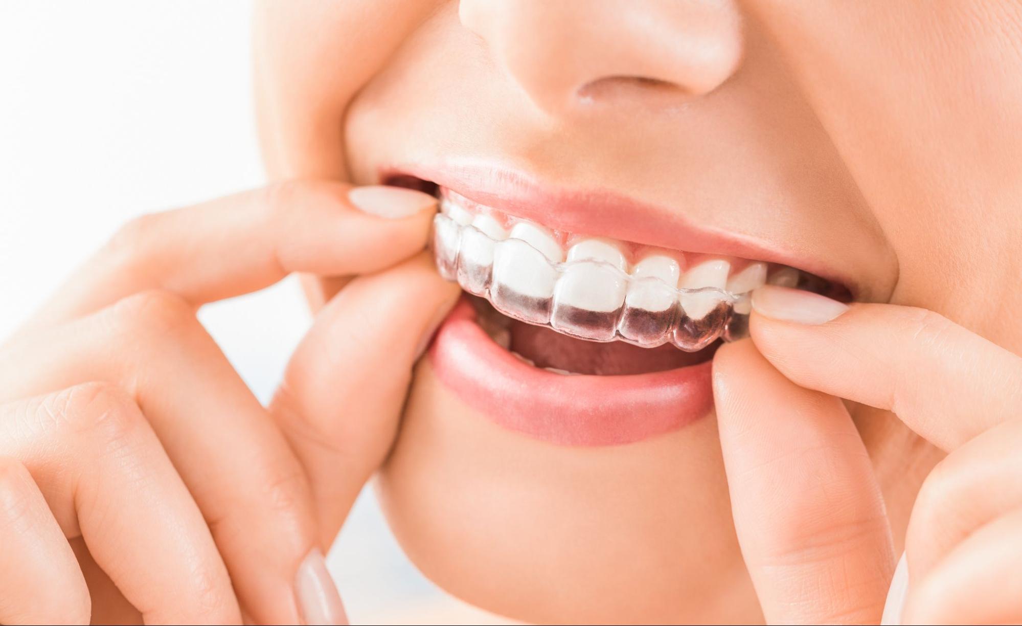 How to Get the Most Our of Your Invisalign